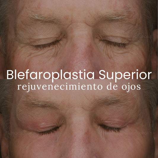 Blefaroplastia Superior