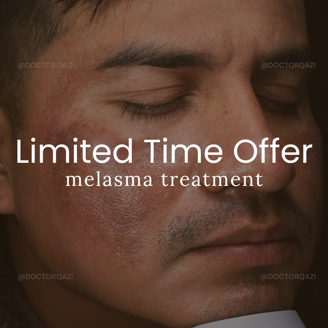 MELASMA TREATMENT - LIMITED TIME OFFER