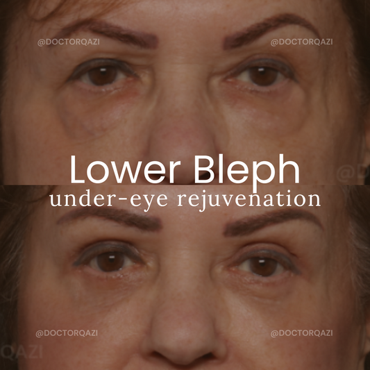 Lower Blepharoplasty With General Anesthesia