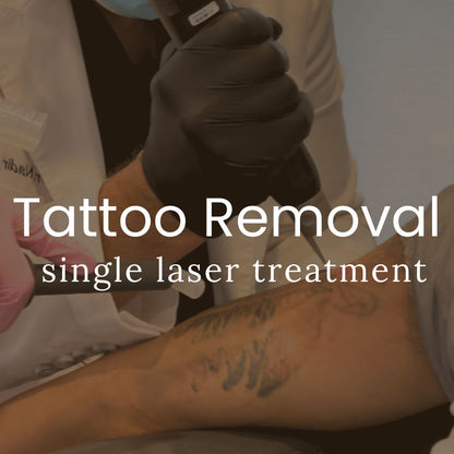 Laser Tattoo Removal