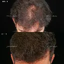 hair loss.webp