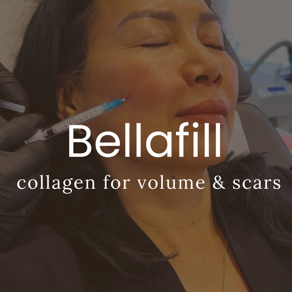 Bellafill Collagen Enhancement Filler