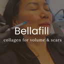 Bellafill Collagen Filler