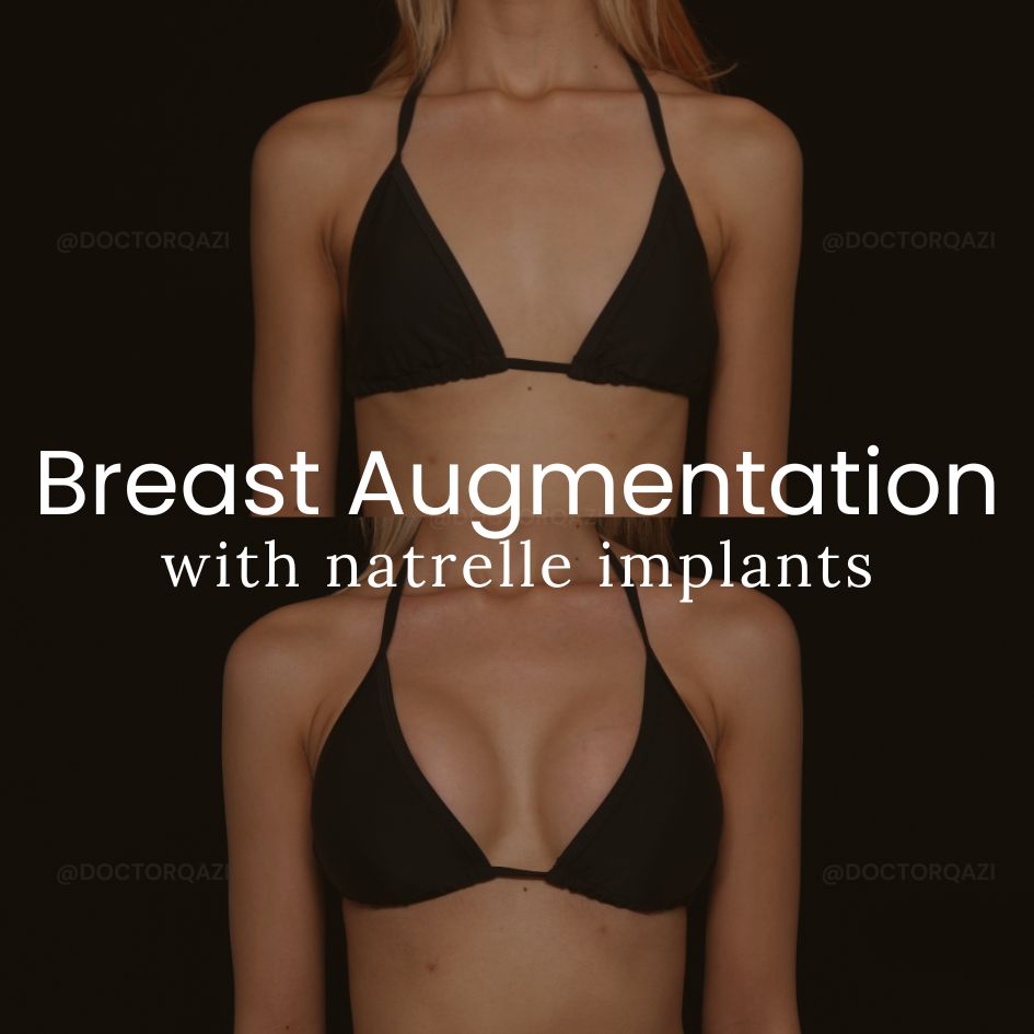 Breast Augmentation with Natrelle Implants