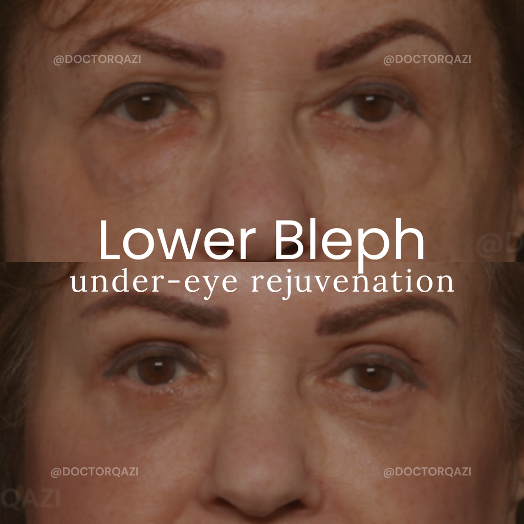 Lower Blepharoplasty
