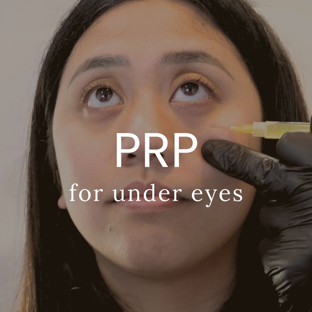 PRP Therapy for Undereye Dark Circles