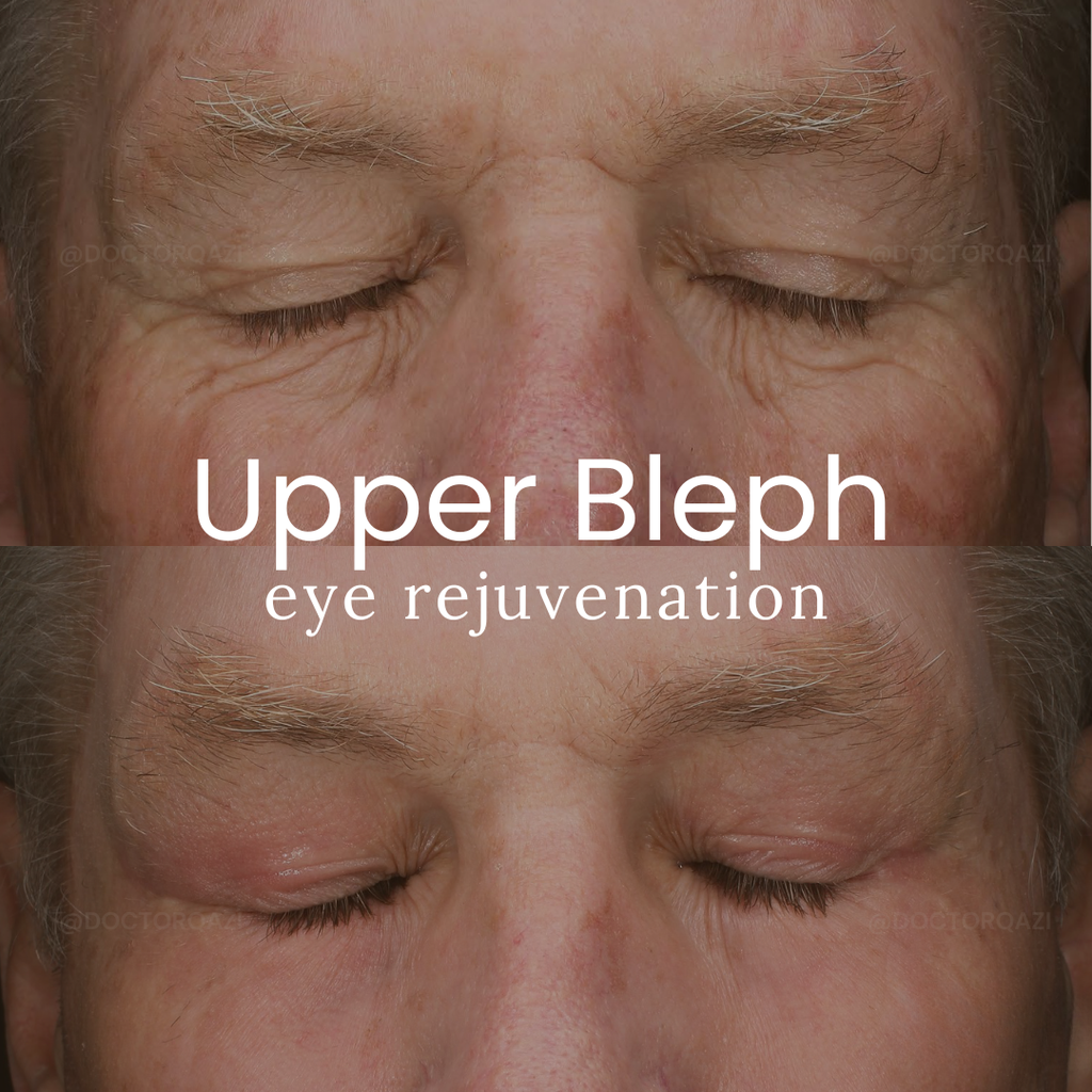 Upper Blepharoplasty