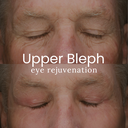 Upper Blepharoplasty