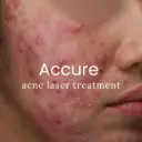 Accure Acne Laser Treatment