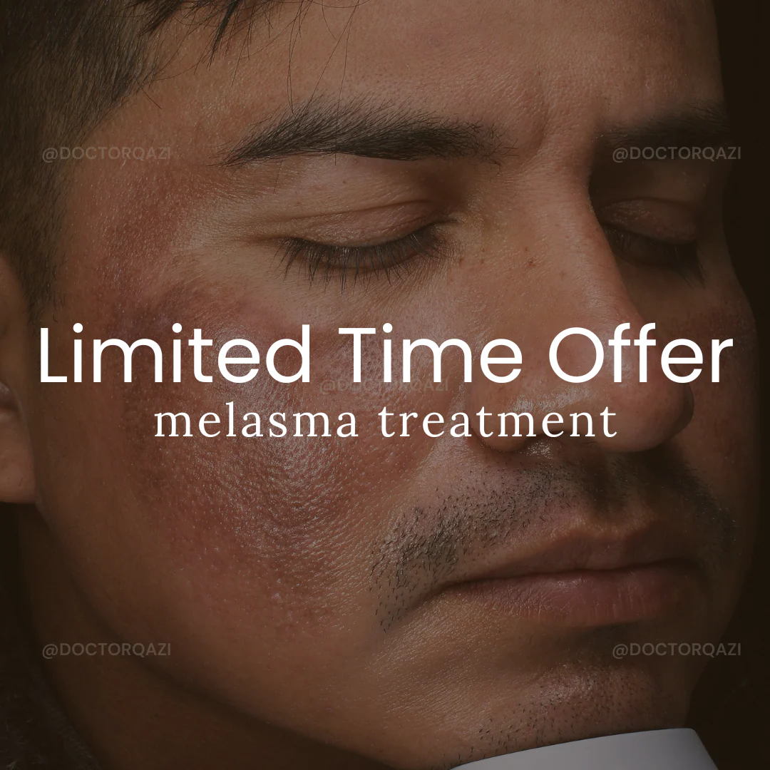 Melasma treatment - Limited Offer