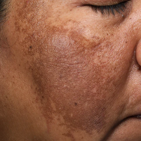 Dark Spots and Melasma