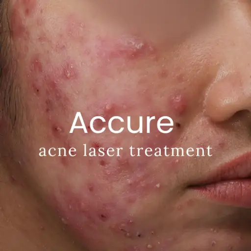 Accure Acne Laser Treatment