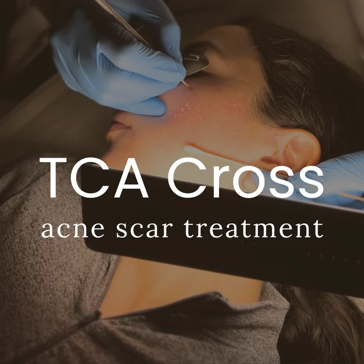 TCA Cross Acne Scar Treatment | Qazi Cosmetic Center