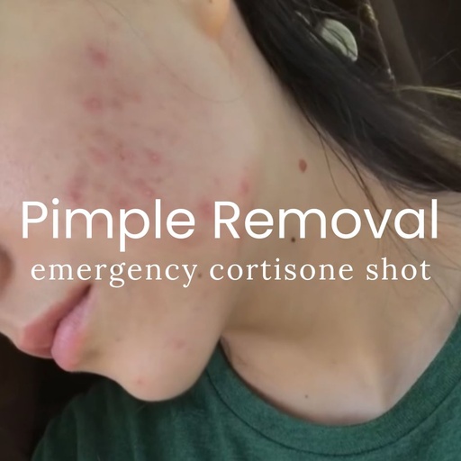 Emergency Pimple Removal Fast