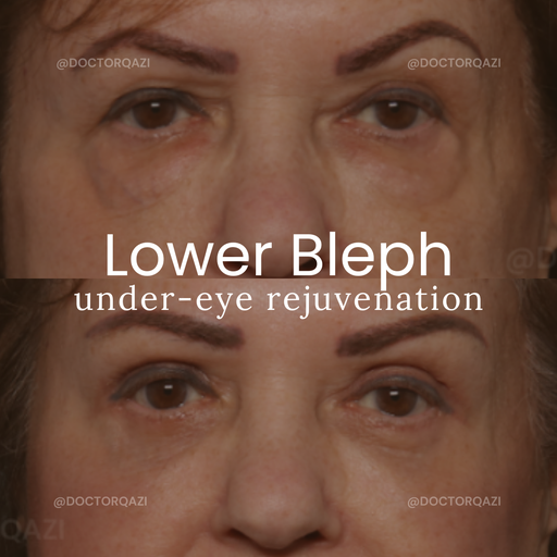 Lower Blepharoplasty