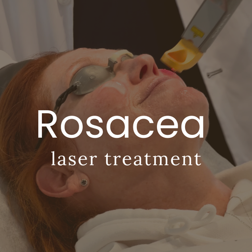 Rosacea Calming Laser Treatment