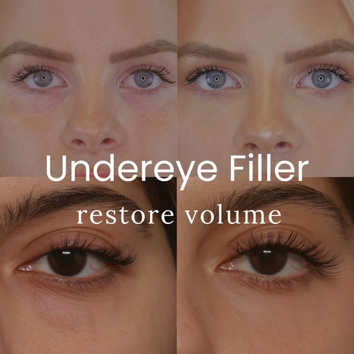 Undereye Filler with Hyaluronic Acid