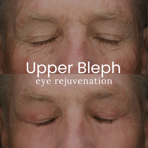 Upper Blepharoplasty